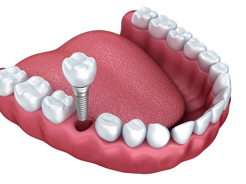 How Long do dental implants last