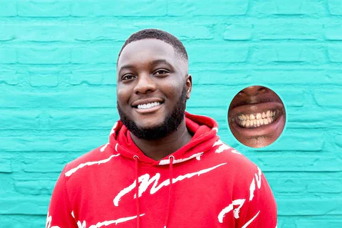 How to hide cavities on front teeth - Instasmile