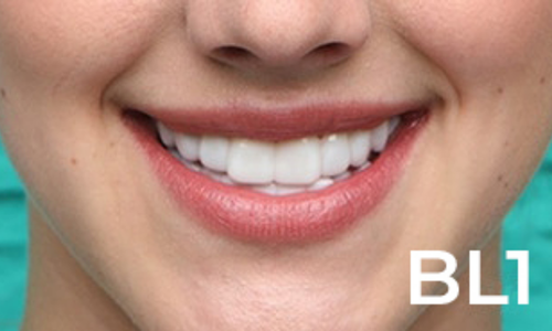 How to achieve a hollywood smile