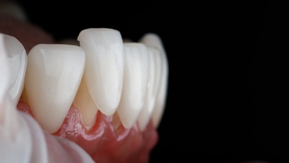 Veneers placed over natural teeth