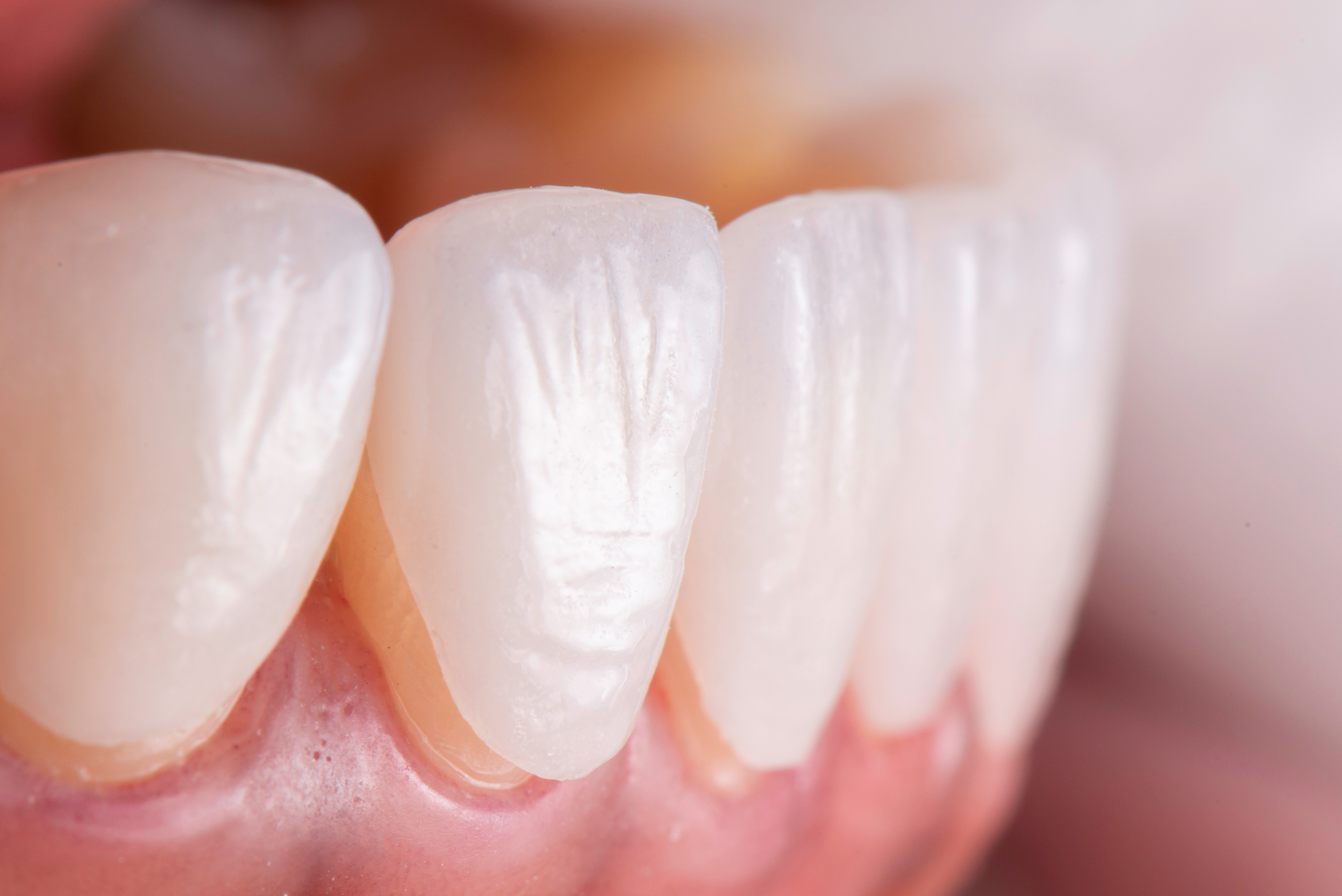 What happens to teeth under veneers - instasmile